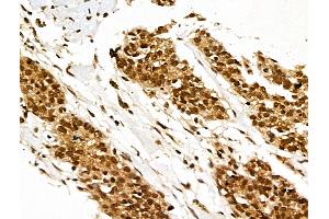 ABIN7094605 and ABIN7098655 at 1/100 staining Human ovarian cancer by IHC-P.