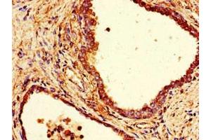 Immunohistochemistry of paraffin-embedded human prostate cancer using ABIN7148014 at dilution of 1:100 (COPE Antikörper  (AA 2-308))