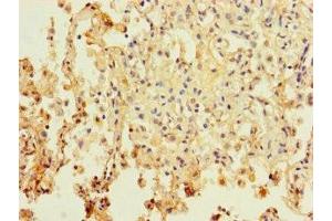 Immunohistochemistry of paraffin-embedded human lung cancer using ABIN7162702 at dilution of 1:100