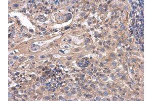 IHC-P Image ACOX3 antibody detects ACOX3 protein at cytoplasm in human cervical carcinoma by immunohistochemical analysis.