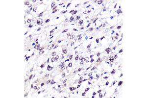 Immunohistochemistry of paraffin-embedded human bladder cancer using FTO Rabbit mAb (ABIN1679842, ABIN3018203, ABIN3018204 and ABIN7101583) at dilution of 1:100 (40x lens). (FTO Antikörper)