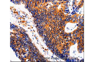 Immunohistochemistry of Human colon cancer using IL18BP Polyclonal Antibody at dilution of 1:50 (IL18BP Antikörper)