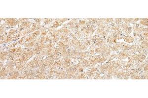 Immunohistochemistry of paraffin-embedded Human liver cancer tissue using NUDT19 Polyclonal Antibody at dilution of 1:25(x200) (NUDT19 Antikörper)