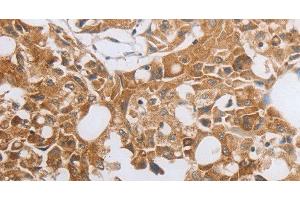 Immunohistochemistry of paraffin-embedded Human lung cancer using MUC20 Polyclonal Antibody at dilution of 1:40