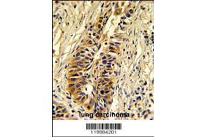 Formalin-fixed and paraffin-embedded human lung carcinoma reacted with TALDO1 Antibody , which was peroxidase-conjugated to the secondary antibody, followed by DAB staining.