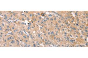 Immunohistochemistry of paraffin-embedded Human liver cancer tissue using STK16 Polyclonal Antibody at dilution of 1:30(x200)
