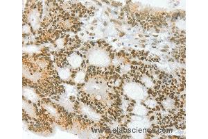 Immunohistochemistry of Human colon cancer using ANGPT4 Polyclonal Antibody at dilution of 1:70 (Angiopoietin 4 Antikörper)