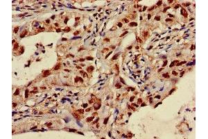 Immunohistochemistry of paraffin-embedded human lung cancer using ABIN7170231 at dilution of 1:100 (SLC35F2 Antikörper  (AA 335-374))