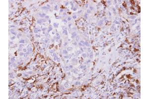 IHC-P Image Iba1 antibody detects Iba1 protein at cytoplasm on human breast cancer stroma by immunohistochemical analysis. (Iba1 Antikörper)