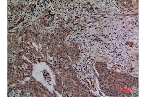 Immunohistochemistry (IHC) analysis of paraffin-embedded Human Breast Cancer, antibody was diluted at 1:100. (MCL-1 Antikörper  (Internal Region))