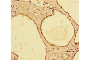 Immunohistochemistry of paraffin-embedded human prostate cancer using ABIN7156292 at dilution of 1:100 (IMPDH2 Antikörper  (AA 5-514))