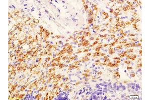 Formalin-fixed and paraffin embedded mouse tumor with labeled Anti-phospho-AKT/PKB(Ser473) Polyclonal Antibody, Unconjugated  at 1:600, followed by conjugation to the secondary antibody and DAB staining (AKT 1/2/3 Antikörper  (pSer473))