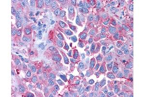 Anti-CRFR1 / CRHR1 antibody IHC of human Lung, Non-Small Cell Carcinoma. (CRHR1 Antikörper  (Extracellular Domain))