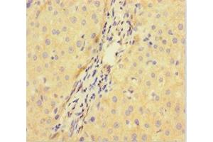 Immunohistochemistry of paraffin-embedded human liver cancer using ABIN7149517 at dilution of 1:100 (DDB1 and CUL4-Associated Factor 1 (DCAF1) (AA 647-745) Antikörper)