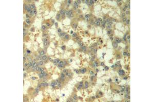 Immunohistochemistry of paraffin-embedded human breast carcinoma using Phospho-SYK-Y323 antibody (ABIN2987845).
