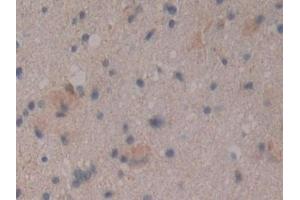 Detection of CD109 in Human Glioma Tissue using Polyclonal Antibody to Cluster Of Differentiation 109 (CD109) (CD109 Antikörper  (AA 1146-1390))