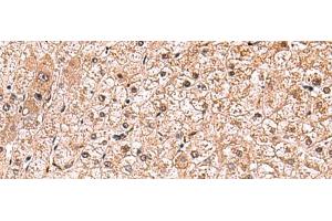 Immunohistochemistry of paraffin-embedded Human liver cancer tissue using RUSC1 Polyclonal Antibody at dilution of 1:90(x200) (RUSC1 Antikörper)