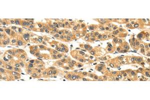 Immunohistochemistry of paraffin-embedded Human liver cancer tissue using NME8 Polyclonal Antibody at dilution 1:45 (TXNDC3/NME8 Antikörper)