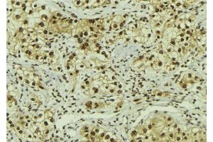 ABIN6267079 at 1/100 staining Human breast cancer tissue by IHC-P. (AC-FKHR Antikörper)