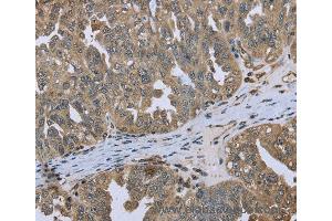 Immunohistochemistry of Human cervical cancer using DCTN4 Polyclonal Antibody at dilution of 1:50