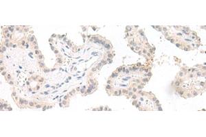 Immunohistochemistry of paraffin-embedded Human thyroid cancer tissue using GHDC Polyclonal Antibody at dilution of 1:90(x200) (GHDC Antikörper)