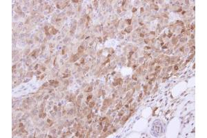 IHC-P Image Immunohistochemical analysis of paraffin-embedded CL1-5 xenograft, using VGAT, antibody at 1:500 dilution. (SLC32A1 Antikörper  (N-Term))