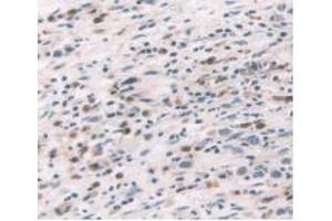 IHC-P analysis of Human Stomach Cancer Tissue, with DAB staining. (TNF alpha Antikörper  (AA 77-233))