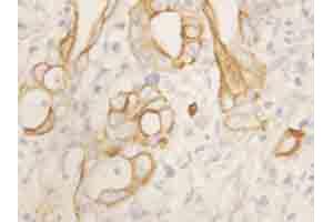 Immunohistochemical staining of TNFRSF1B on formalin fixed, paraffin embedded human intestinal cancer with TNFRSF1B polyclonal antibody . (TNFRSF1B Antikörper  (N-Term))