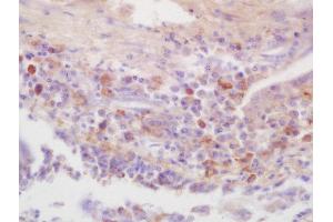 Formalin-fixed and paraffin embedded human lung carcinoma labeled with Rabbit Anti-IRAK4(Thr345) Polyclonal Antibody, Unconjugated (ABIN2177052) at 1:200 followed by conjugation to the secondary antibody and DAB staining