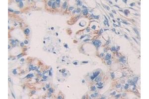 IHC-P analysis of Human Bile duct cancer Tissue, with DAB staining. (KIR2DL2 Antikörper  (AA 22-348))