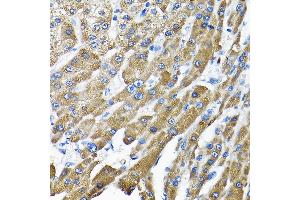 Immunohistochemistry of paraffin-embedded human liver cancer using THUMPD3 Rabbit pAb (ABIN6132951, ABIN6149133, ABIN6149134 and ABIN6214652) at dilution of 1:200 (40x lens). (THUMPD3 Antikörper  (AA 1-250))