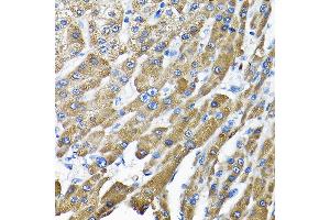 Immunohistochemistry of paraffin-embedded human liver cancer using THUMPD3 Rabbit pAb (ABIN6132951, ABIN6149133, ABIN6149134 and ABIN6214652) at dilution of 1:200 (40x lens). (THUMPD3 Antikörper  (AA 1-250))