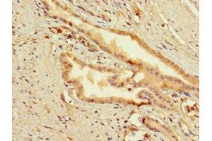 Immunohistochemistry of paraffin-embedded human prostata cancer using ABIN7159849 at dilution of 1:100