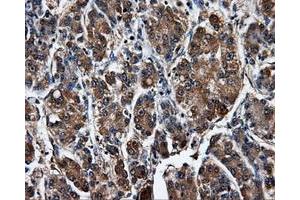 Immunohistochemical staining of paraffin-embedded Carcinoma of liver tissue using anti-SATB1mouse monoclonal antibody. (SATB1 Antikörper)