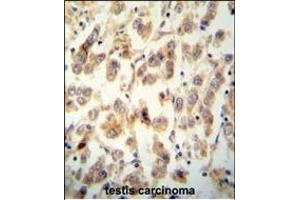 TTC16 antibody (N-term) (ABIN654516 and ABIN2844240) immunohistochemistry analysis in formalin fixed and paraffin embedded human testis carcinoma followed by peroxidase conjugation of the secondary antibody and DAB staining. (TTC16 Antikörper  (N-Term))