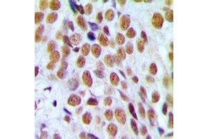 Immunohistochemical analysis of Progesterone Receptor staining in human breast cancer formalin fixed paraffin embedded tissue section. (Progesterone Receptor Antikörper)