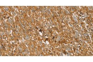 Immunohistochemistry of paraffin-embedded Human gastric cancer using TMPRSS11F Polyclonal Antibody at dilution of 1:30 (TMPRSS11F Antikörper)