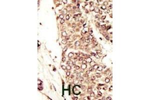 Formalin-fixed and paraffin-embedded human cancer tissue reacted with the primary antibody, which was peroxidase-conjugated to the secondary antibody, followed by AEC staining. (IGF1R Antikörper  (C-Term))