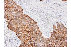 IHC-P Image Immunohistochemical analysis of paraffin-embedded Lung CA, using Cytokeratin 14, antibody at 1:100 dilution.