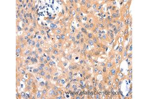Immunohistochemistry of Human cervical cancer using MYL9 Polyclonal Antibody at dilution of 1:80
