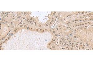 Immunohistochemistry of paraffin-embedded Human thyroid cancer tissue using PCLAF Polyclonal Antibody at dilution of 1:50(x200) (KIAA0101 Antikörper)