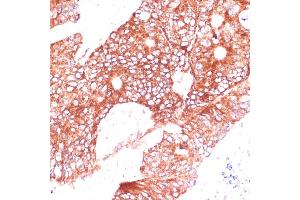 Immunohistochemistry of paraffin-embedded human colon carcinoma using FA antibody (ABIN7267121) at dilution of 1:100 (40x lens). (FAM98A Antikörper  (AA 1-220))