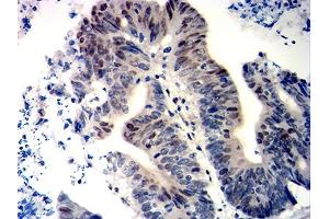 Immunohistochemical analysis of paraffin-embedded colon cancer tissues using WT1 mouse mAb with DAB staining. (WT1 Antikörper  (AA 1-181))