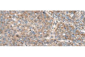 Immunohistochemistry of paraffin-embedded Human liver cancer tissue using CADM2 Polyclonal Antibody at dilution of 1:40(x200) (CADM2 Antikörper)