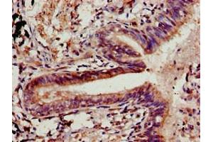 Immunohistochemistry of paraffin-embedded human lung cancer using ABIN7147907 at dilution of 1:100 (Claudin 5 Antikörper  (AA 181-218))