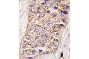 Formalin-fixed and paraffin-embedded human breast carcinoma tissue reacted with PI3KC2B antibody (N-term), which was peroxidase-conjugated to the secondary antibody, followed by DAB staining. (PIK3C2B Antikörper  (N-Term))