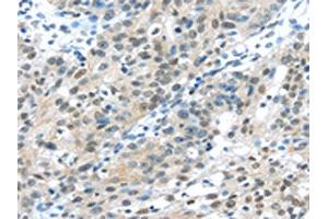The image on the left is immunohistochemistry of paraffin-embedded Human breast cancer tissue using ABIN7131359(TKT Antibody) at dilution 1/30, on the right is treated with fusion protein. (TKT Antikörper)
