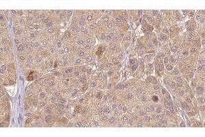 ABIN6277349 at 1/100 staining Human Melanoma tissue by IHC-P. (CTGF Antikörper  (Internal Region))