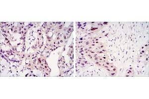 Immunohistochemical analysis of paraffin-embedded mammary cancer tissues (left) and lung cancer tissues (right) using STAT3 antibody with DAB staining. (STAT3 Antikörper)