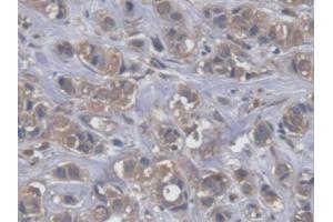 IHC-P analysis of Human Breast cancer Tissue, with DAB staining. (EEF2 Antikörper  (AA 32-233))
